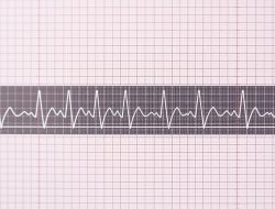 Memahami EKG Jantung: Mengecek Kondisi Kesehatan Anda